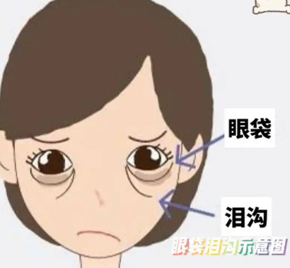 去眼袋手术
