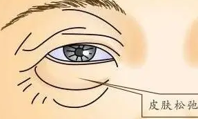 去眼袋手术