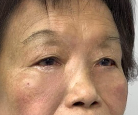 去眼袋手术