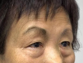 去眼袋手术