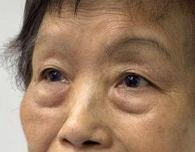 去眼袋手术