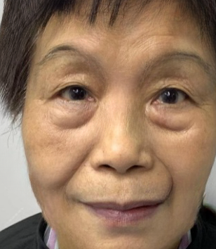 去眼袋手术