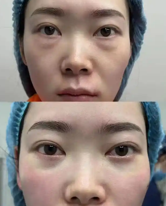 去眼袋手术