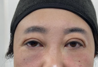 去眼袋手术