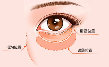 去眼袋手术
