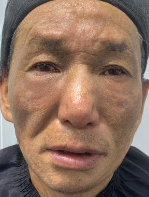 去眼袋手术
