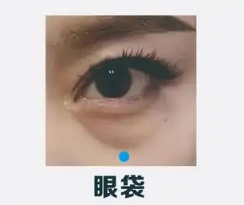去眼袋手术