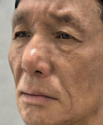 去眼袋手术