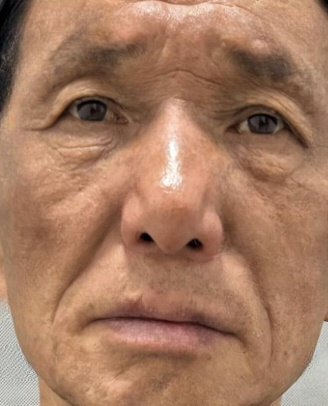 去眼袋手术