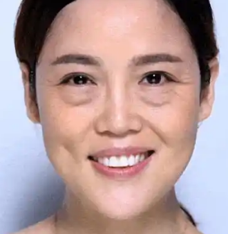 眼袋