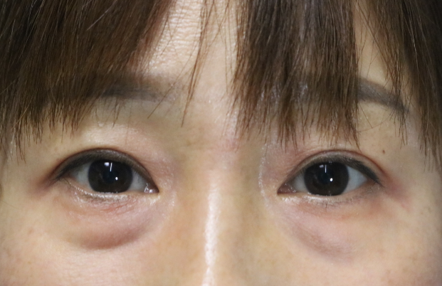 眼袋