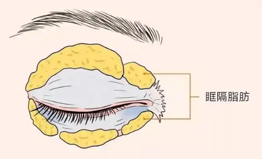 眼袋