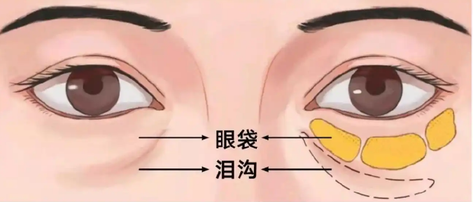 眼袋