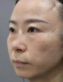 去眼袋手术