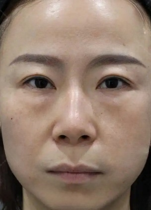 去眼袋手术