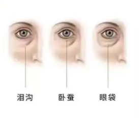 眼袋
