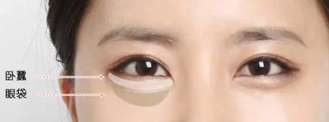 去眼袋手术