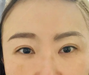 去眼袋手术
