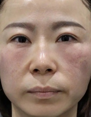 去眼袋手术