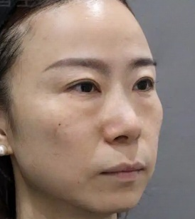 去眼袋手术