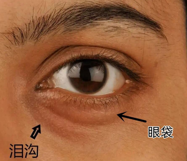 眼袋