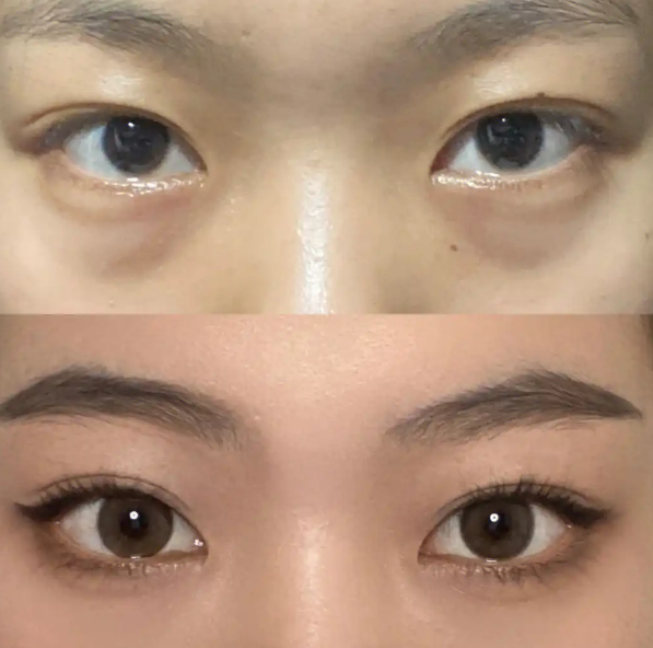 眼袋