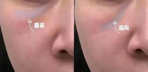 眼袋