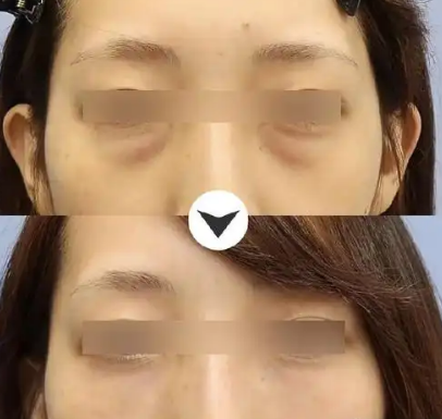 去眼袋手术