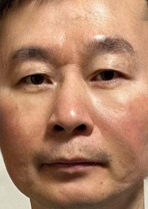 去眼袋手术