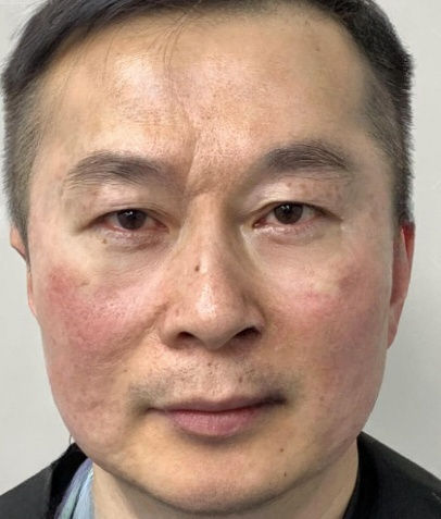 去眼袋手术