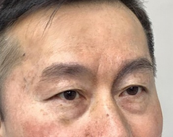 去眼袋手术
