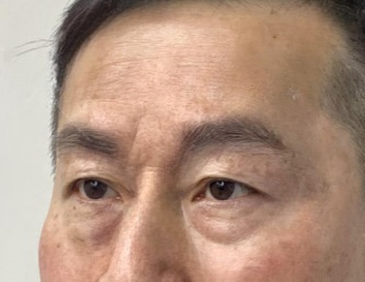 去眼袋手术