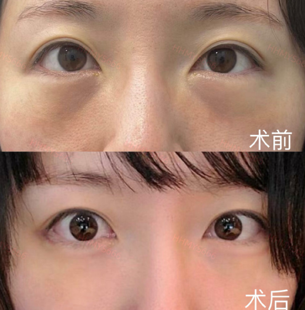 去眼袋手术