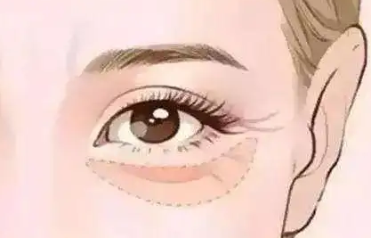 去眼袋手术