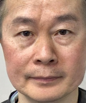 去眼袋手术