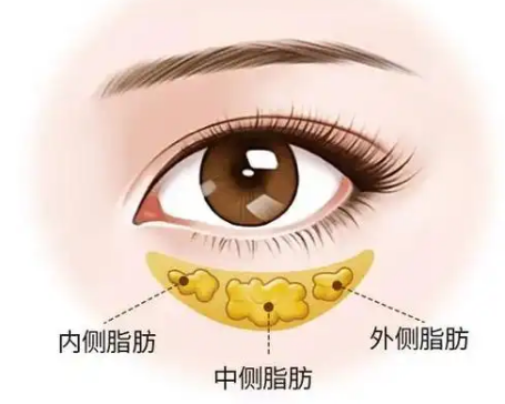 去眼袋手术