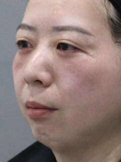 去眼袋手术