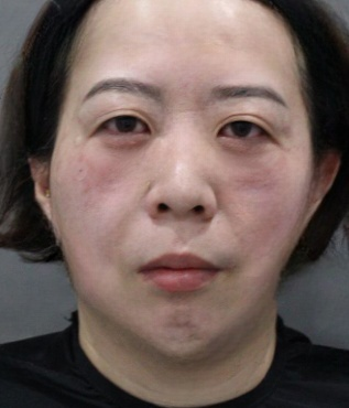 去眼袋手术