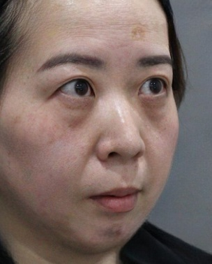 去眼袋手术