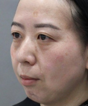 去眼袋手术