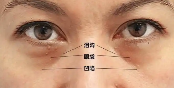 去眼袋手术