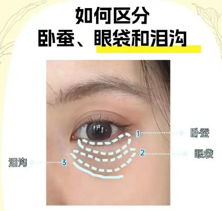 去眼袋手术
