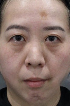 去眼袋手术