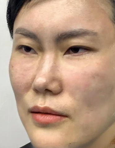 去眼袋手术