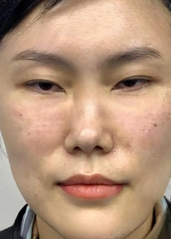 去眼袋手术