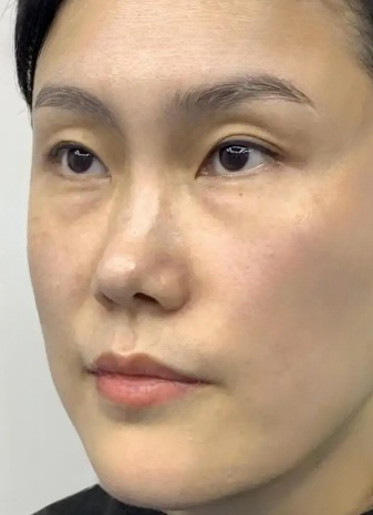 去眼袋手术