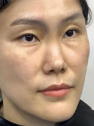 去眼袋手术