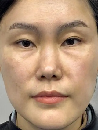 去眼袋手术