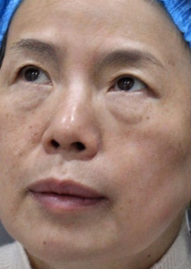 去眼袋手术