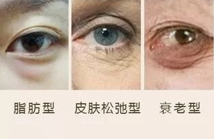 去眼袋手术